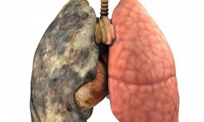 Абсцес легені - симптоми і скарги, діагностика, лікування та профілактика.