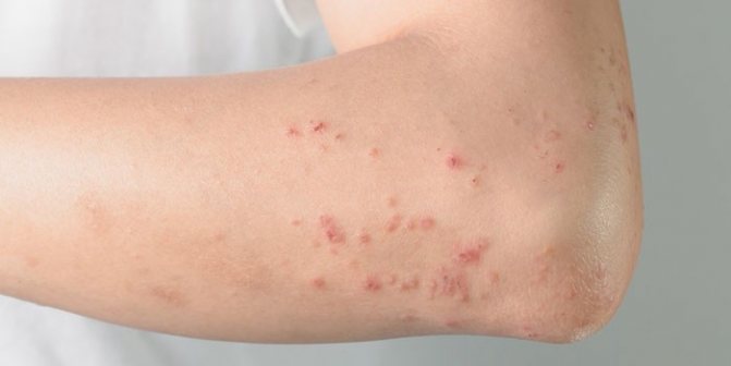 Алергічний висип на шкірі руки