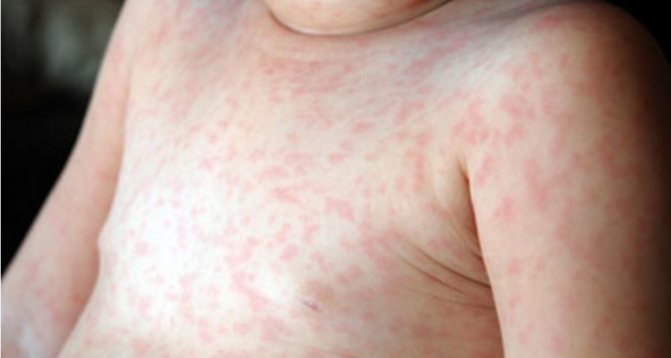 Алергічний висип у новонародженого