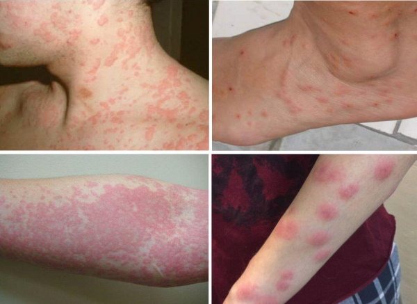 Алергія на шкірі у дорослих.  Фото, види, як лікуваті пухірі, червоні плям, свербіння.  Мазі, харчування, трави