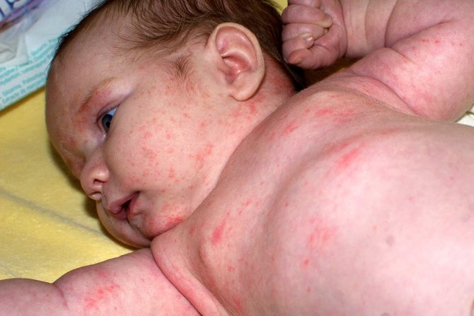Алергія по всьому тілу малюка