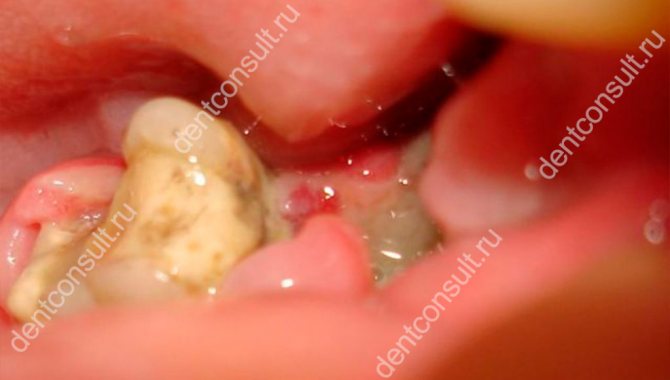 альвеоліт після видалення зуба