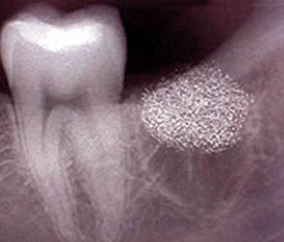 Альвеолит зуба на рентгені
