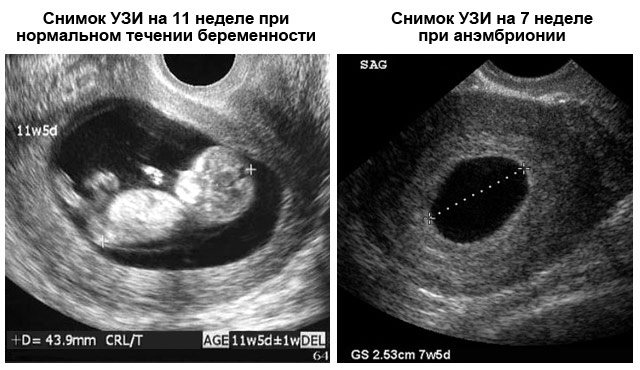 анембріонія на знімку УЗД