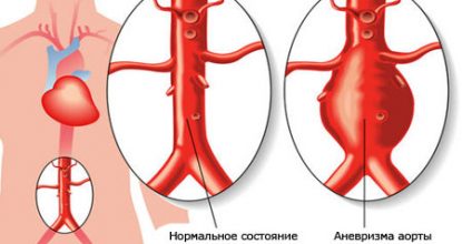 Аневризма черевної аорти