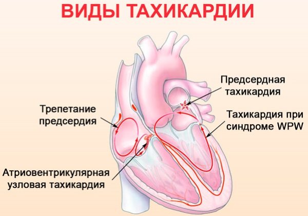 Аритмія серця. Чим небезпечна, причини, симптоми, як лікувати в домашніх умовах