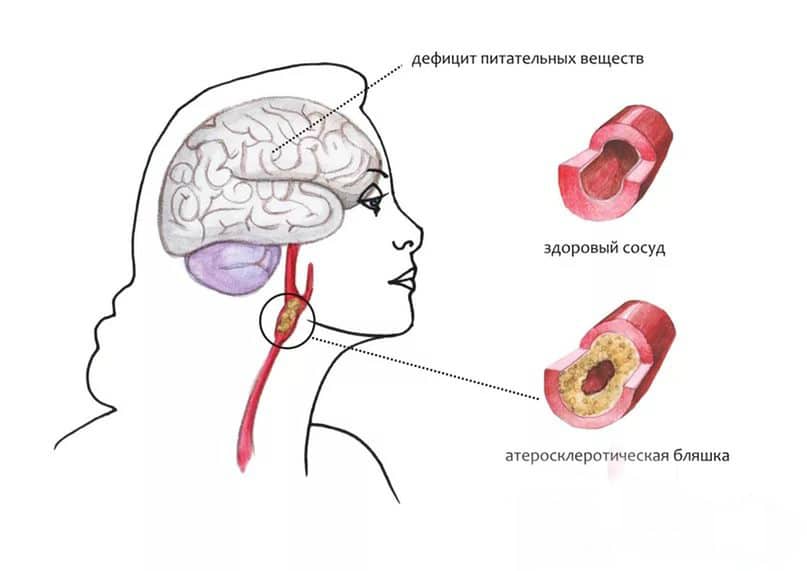 Атеросклероз головного мозку
