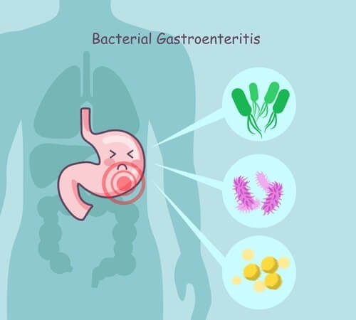 Бактеріальний гастроентерит людини