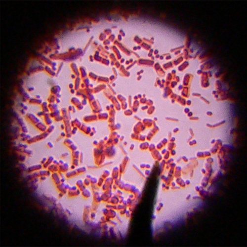 бактерії Коха при закритій формі туберкульозу