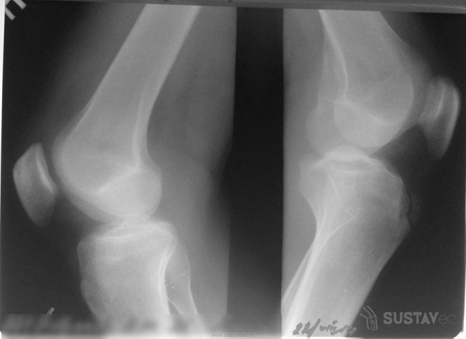 Хвороба Шляттера колінного суглоба: як лікувати? 11-4