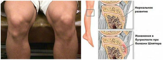 Хвороба Шляттера колінного суглоба: симптоми і лікування, код за МКБ ...