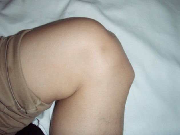 Хвороба Осгуд-Шляттера колінного суглоба у підлітків: лікування, причини та симптоми