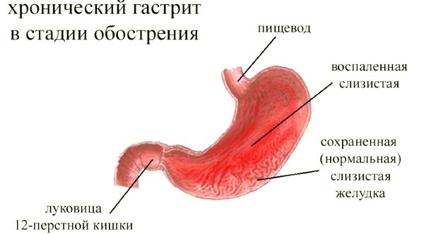 Часта причина хронічного гастриту типу «В» - прісутність в шлунково середовіщі бактерії хелікобактер пілорі.