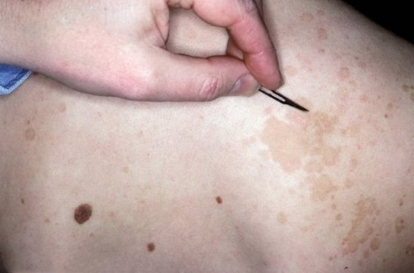 Кольоровий лишай у людини. Фото, ознака, стадії, лікування народними засоби, препарати