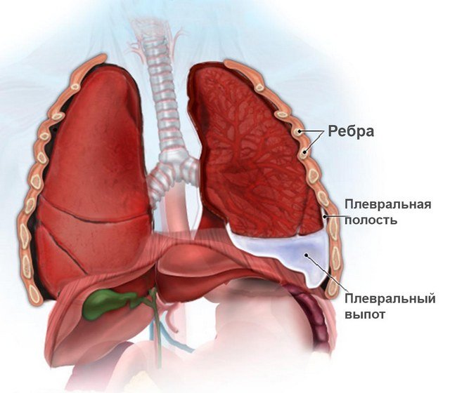 Даже таке захворювання легенів, як плеврит, может стать причиною болів между лопатками