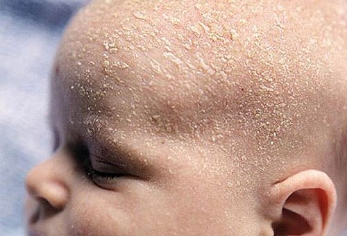 дерматит на голові дитини
