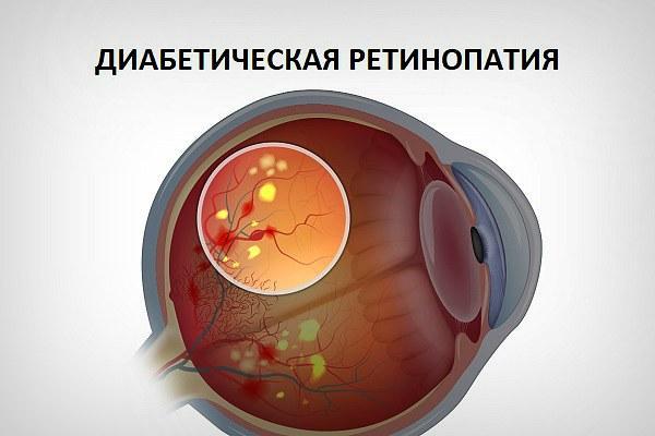 діабетична ретинопатія