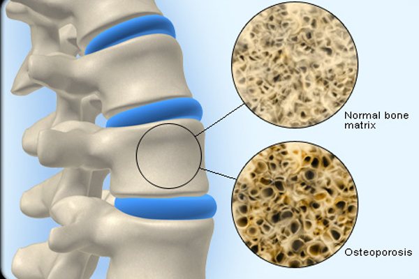 діагностика остеопорозу у жінок