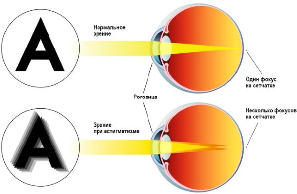 Диплопія. Причини, симптоми і лікування захворювання очей, клінічні рекомендації