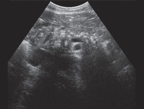 Ехограма хронічного псевдотуморозного панкреатиту - кальцинати в паренхімі підшлункової залози