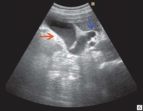 Ехограма низького печінкового блоку, обумовленого пухлиною головки ПЖ - збільшений жовчний міхур з густою суспензією (червона стрілка) і розширений ОЖП (синя стрілка)