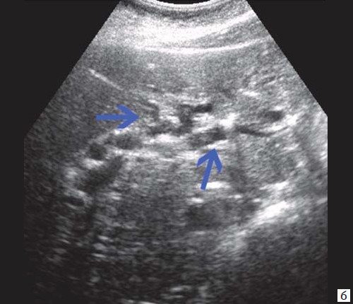 Ехограма пухлини великого дуоденального сосочка - розширення внутріпечоночних проток (синя стрілка)