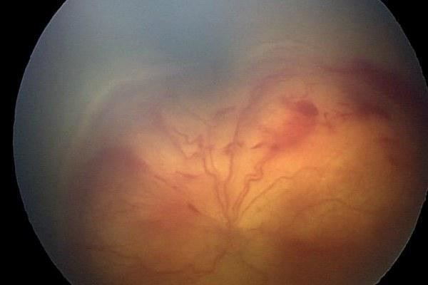 Ексудативна ретинопатія сітківки ока