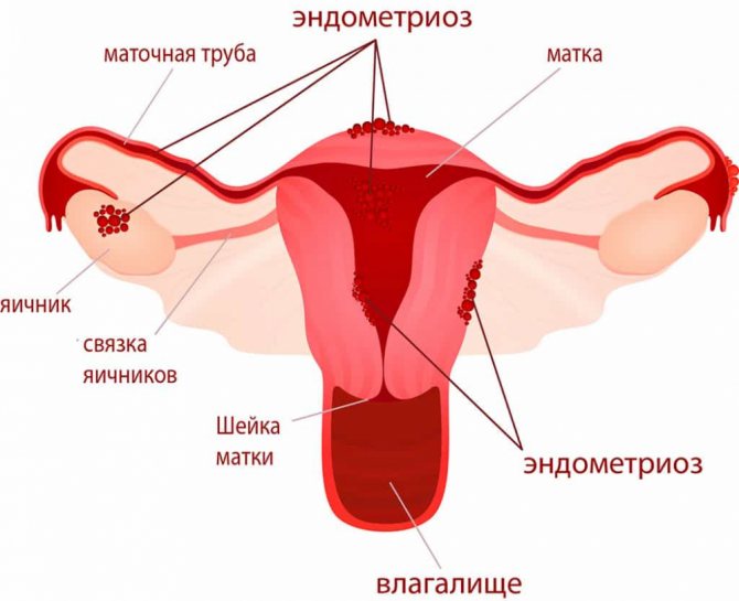 Ендометріоз: матки, Шийки, тела;  Симптоми и лікування;  фото