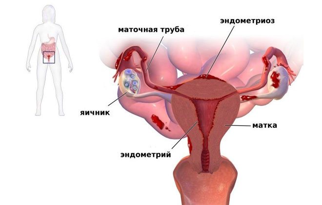 ендометріоз жіночий