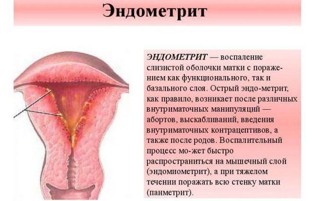 ендометрит