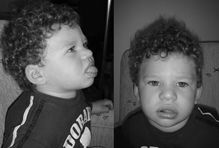 Если дитина має дивний вирази лица, часто язик вісунутій з рота, то Варто Показати его фахівцеві