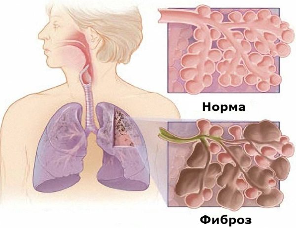 Фіброзні зміни в легенях. Що це, причини, фото дифузні, локальні, після пневмонії, післяопераційні. Як лікувати