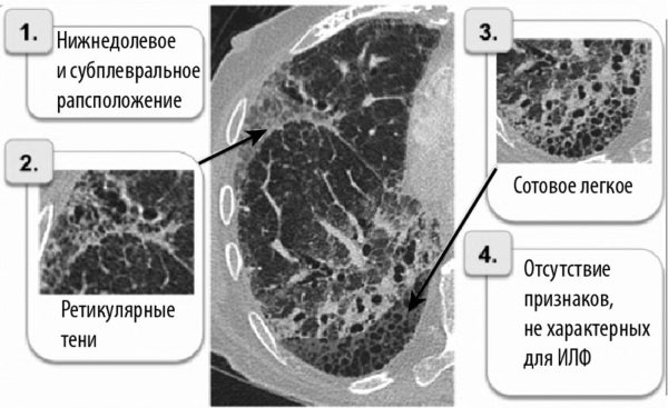 Фіброзні зміни в легенях. Що це, причини, фото дифузні, локальні, після пневмонії, післяопераційні. Як лікувати