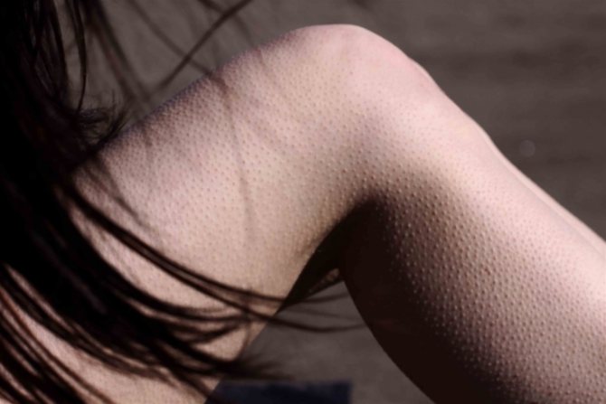 'Фолікулярний гіперкератоз (дерматит) шкіри у дитини: як лікувати