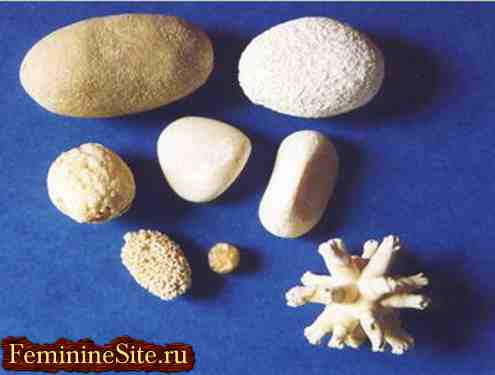 Фосфатні камені в Нирко - причини, лікування, дієта