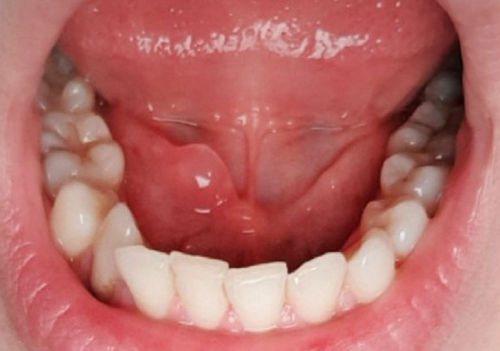 Фото запалення слинної залози під язиком