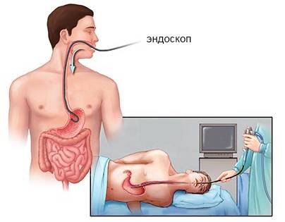 гастроскопия шлунка