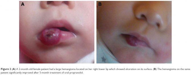 Гемангіома на губі у дорослих: причини виникнення, лікування на слизових нижньої і верхньої губи