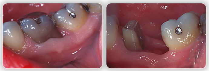 Гемісекція кісти зуба