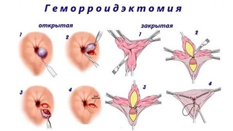 геморроїдектомія