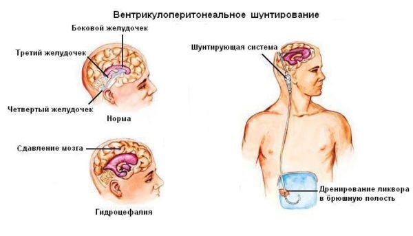 гідроцефалія - ​​набряк головного мозку