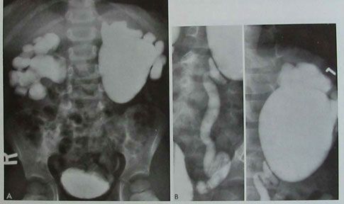 Гідронефроз на рентгенограмі