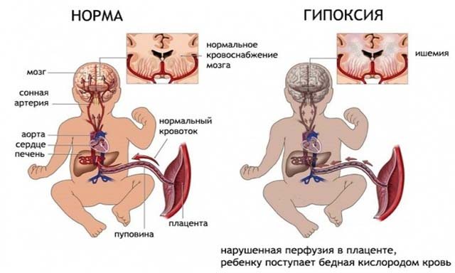 гіпоксія ембріона