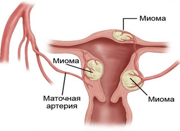 Гормонозамісна терапія для жінок після 40, 50, 60 років, при клімаксі, ГЗТ після видалення матки і яєчників. Фітотерапія, препарати: за і проти