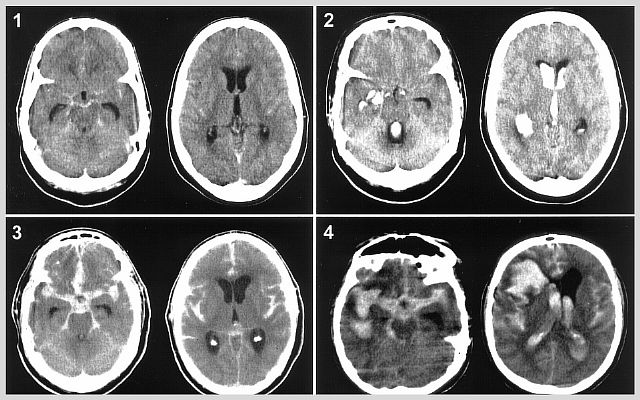 Хронічна ішемія (ішемічна атака) головного мозком