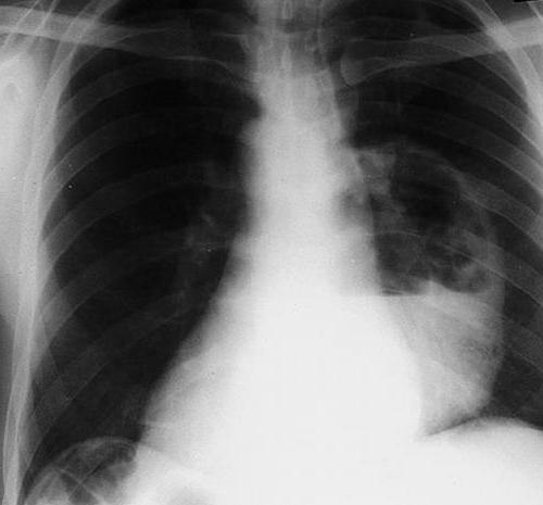 хронічний абсцес легені