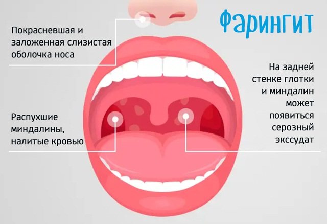 Хронічний фарингіт. Симптоми і лікування у дорослих, препарати, народні засоби