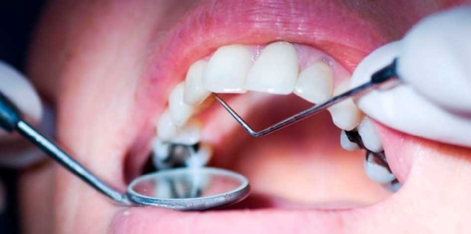 Карієс зубів: Лікування та інноваційні методи в "Мій стоматолог"