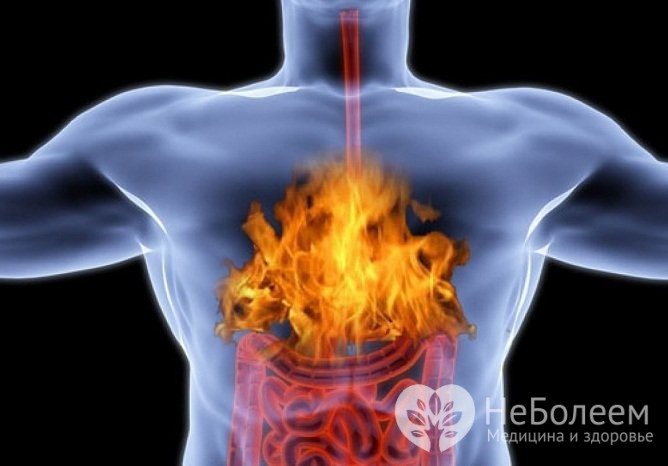 Печія - основний симптом підвищеної кислотності шлунка