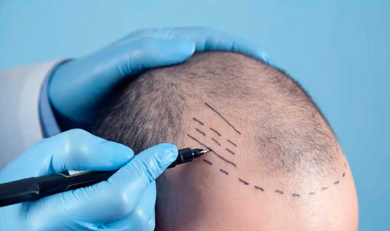 Трансплантация волос в Турции: особенности современной хирургии о которых следует знать